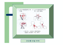 [통증의학] 근막통[Myofascial Pain] 과 만성통증[chronic pain]-5