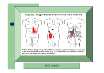 [통증의학] 근막통[Myofascial Pain] 과 만성통증[chronic pain]-8