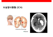 뇌심혈관질환의 이해 및 예방-10